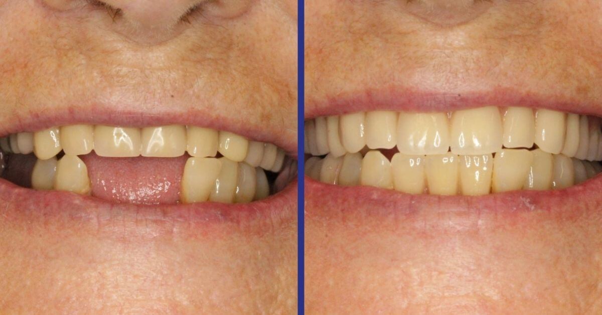 Dentures Before & After